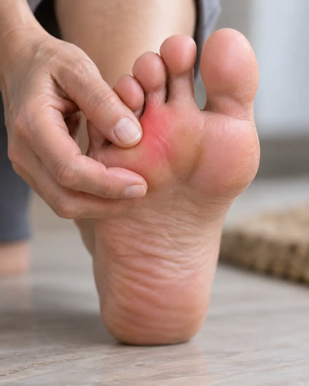Região do antepé associada aos sintomas do neuroma de Morton